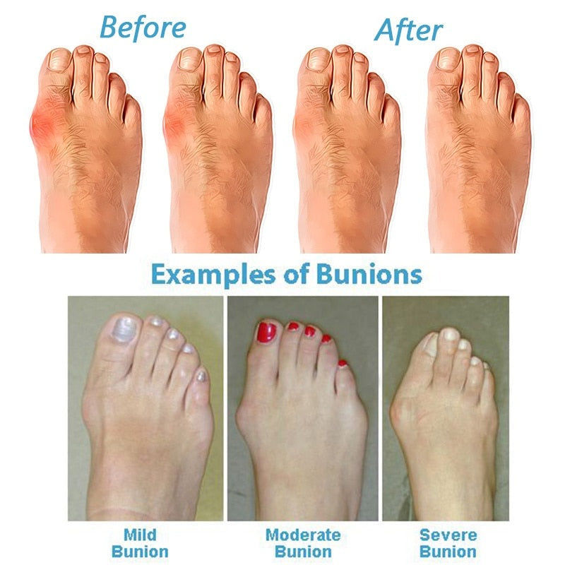 Women's Casual Wedge Sandals Orthopedic Bunion Corrector PU Leather Thong Shoes